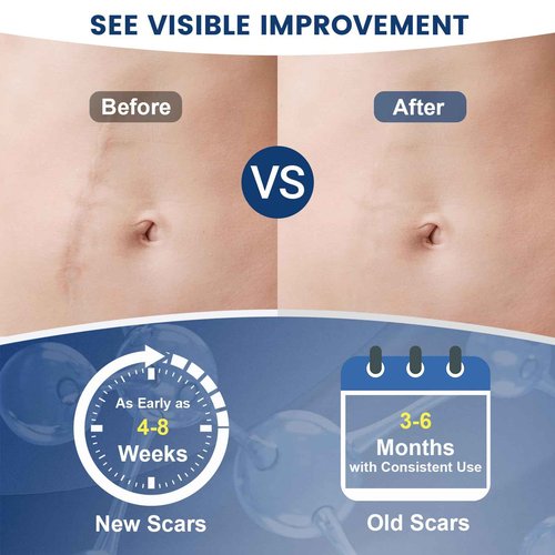 Rvlaim 100% Silicone Scar Gel Scar Cream, Advanced Silicone Gel for Removal of Surgical, Burns, Acne Scar, Old and Recent Scars and Stretch Marks, 1.7 oz/50ml