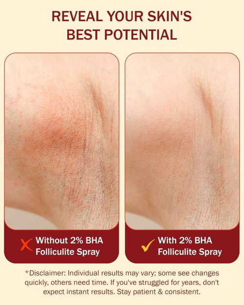 e70 Folliculitis Treatment 2% BHA Body Spray - Salicylic Acid with Tea Tree Oil & Aloe Vera - Spray Moisturizer for Dry Skin, Clogged Pores & Irritation by Made in USA, 4 fl. oz