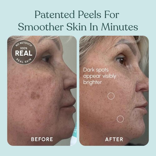 Beautiste 30 DAY MIRACLE AHA 30% + BHA 2% Peeling Solution - Clinical Strength Liquid Exfoliant for Dark Spots, Blackheads & Clogged Pores - Resurfacing Salicylic Acid Serum & Chemical Peel for Face