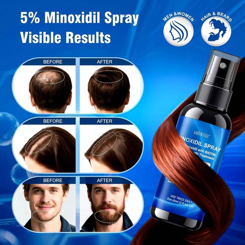 5% Minoxidil Spray for Men and Women,Infused with Biotin, Hair Growth Treatment,Topical hair growth serum,Supports Thicker and Fuller Hair & Beard (6 Pcs,12 Fl Oz Total,6 Month Supply)