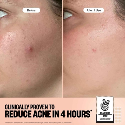 PEACE OUT Acne Healing Dots Helps Clear Blemishes Overnight, Fast Acting Hydrocolloid Pimple Patches for Breakouts with Salicylic Acid, Retinol and Aloe Vera, Award Winning Skincare Solution 40 Count