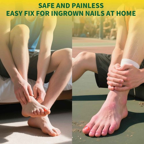 Large Size-Titanium Alloy Ingrown Toenail Treatment & Removal Kit for Quick Relief, Ingrown Toenail Removal Kit， Professional Ingrown Toenail Corrector, Ingrown Toenail Tools for Quick Relief, 10 Pcs