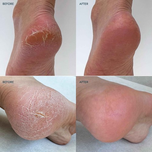 VOESH Heel Repair Duo, Solemate Heel Repair Balm & Moisturizing Heel Socks, Cracked Heel Stick Balm, Foot Care for Men & Women, at-Home Foot Care, K-Beauty Korean Skincare - Lavender