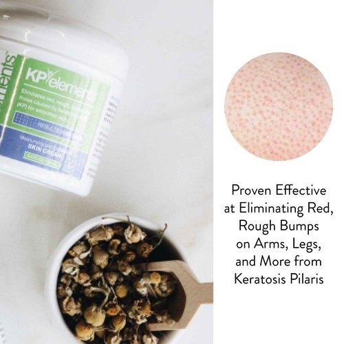 KP Elements Keratosis Pilaris Lotion (4 fl oz) - Natural Keratosis Pilaris Treatment, Moisturizing & Exfoliating AHA Lotion for KP, Vegan, Made in USA