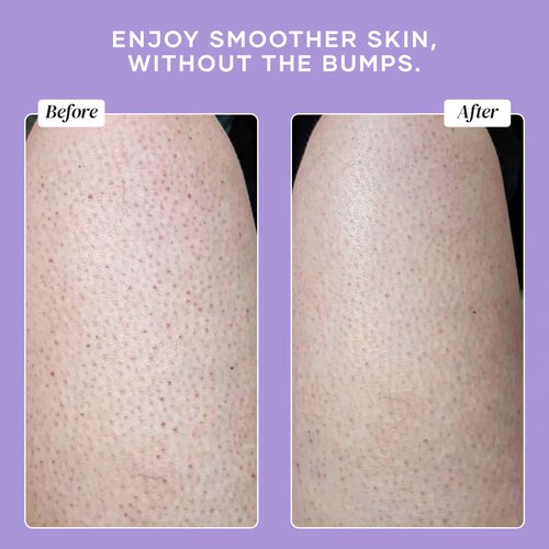 DERMAdoctor KP Bump Eraser Body Scrub with 10% AHAs + PHAs for Keratosis Pilaris, Dry, Rough, and Bumpy Skin, Dermatologist Formulated Exfoliating Body Scrub with Glycolic and Lactic acids - 16 Fl oz