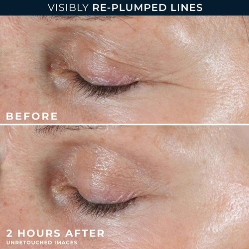 RoC Retinol Correxion Deep Wrinkle Non-Invasive Targeted Patches with Hyaluronic Acid + Firming Peptides for Forehead, 11 Lines, Crow’s Feet and Laugh Lines, (6 Patches) with Retinol Eye Packette