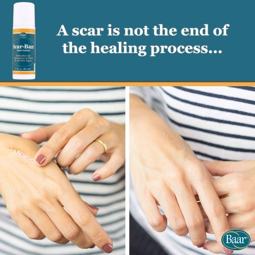 Baar Scar Ban Roll On, 3 oz. (Pack of 2)