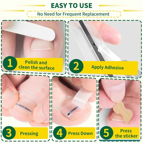 Large Size-Titanium Alloy Ingrown Toenail Treatment & Removal Kit for Quick Relief, Ingrown Toenail Removal Kit， Professional Ingrown Toenail Corrector, Ingrown Toenail Tools for Quick Relief, 10 Pcs