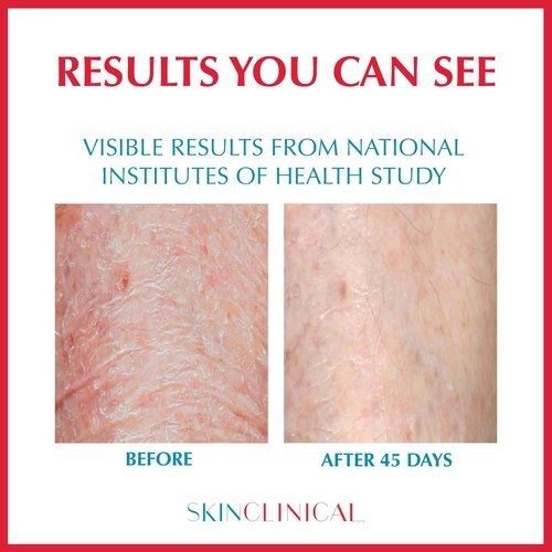 SkinClinical Daily Restore Hydrating and Moisturizing Body Lotion For Very Dry Skin, Psoriasis and Eczema Aftercare, Nourishes Skin with SBD-4 Patented Ingredient, Unscented Body and Face Lotion, 6 oz