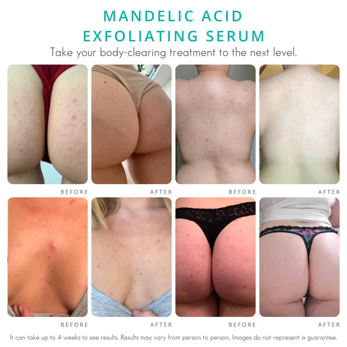Body Exfoliating Serum for Acne and Blemishes - Mandelic Acid Level 2 - Unscented