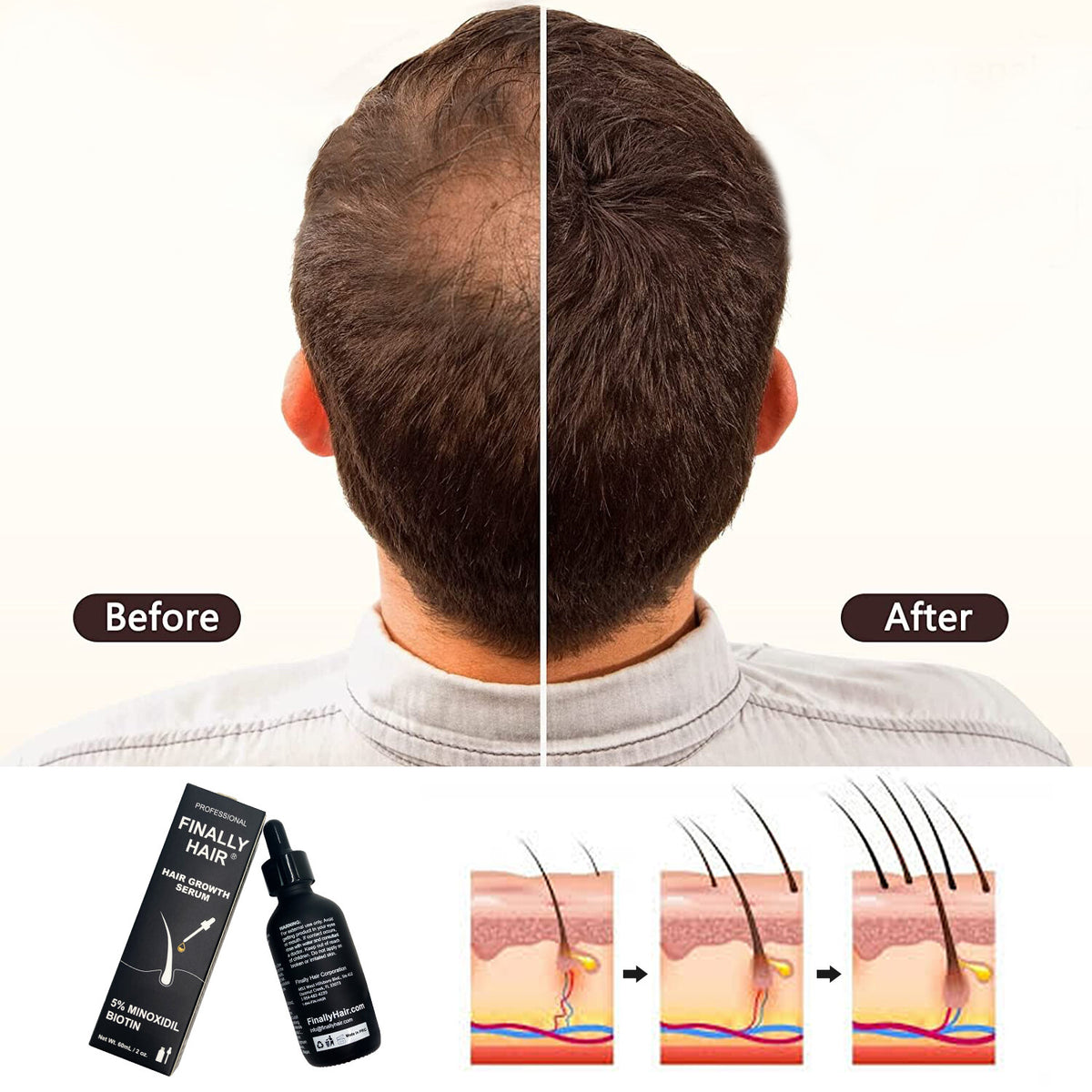 Minoxidil 5% Hair Growth Serum with Biotin & Collagen