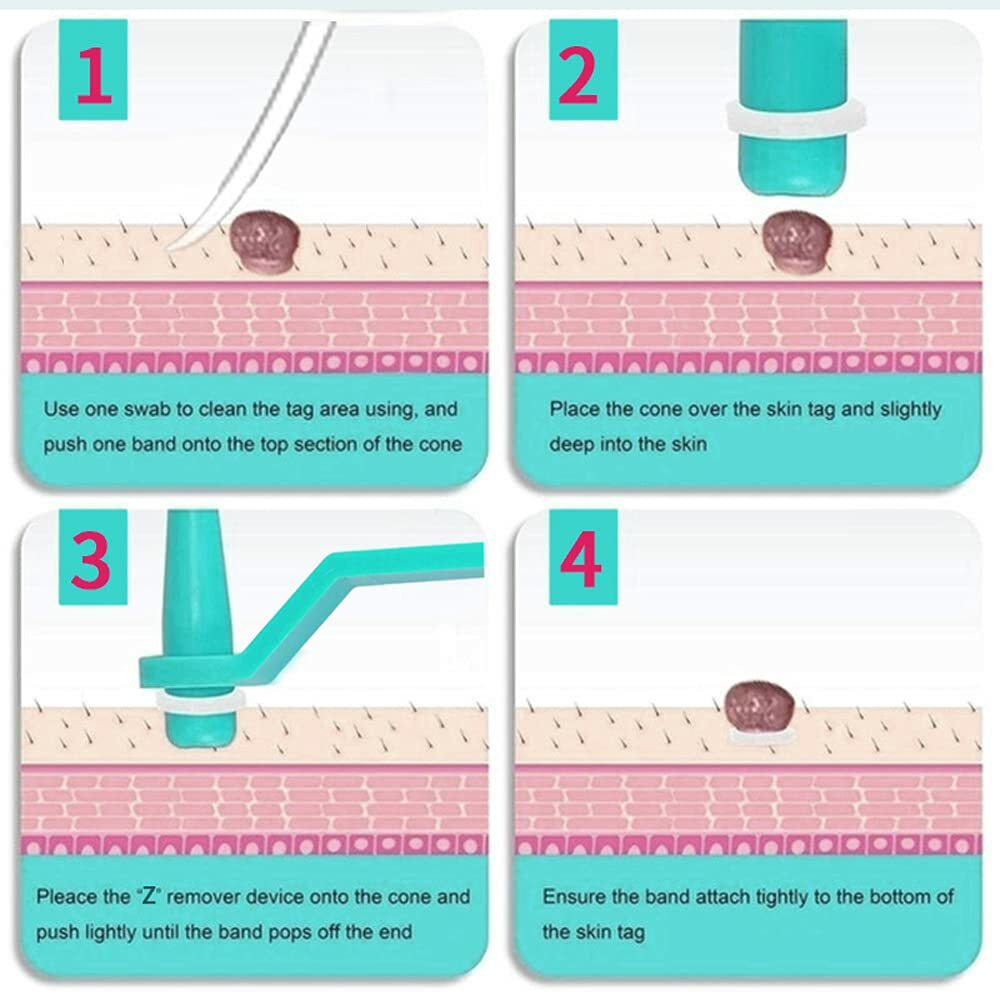 Skin Tag Remover Kit - Painless Wart & Acne Skin Tag Removal Device Set