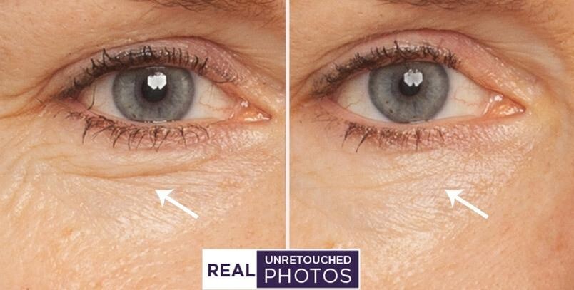 Retinol Vitamin A Serum with Hyaluronic Acid & Vitamin E for Wrinkles