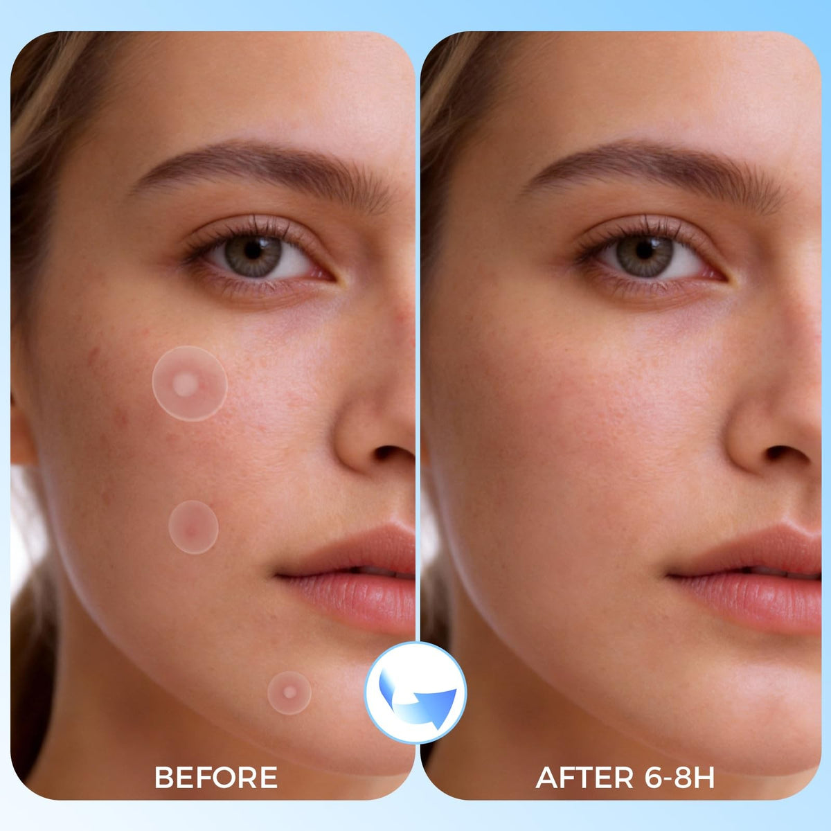 Hydrocolloid Acne Patches with Natural Ingredients - 320 Count, Invisible Spot Treatment