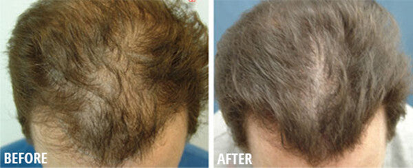 Hair Loss Conditioner - 16 Organic Oils for Men & Women