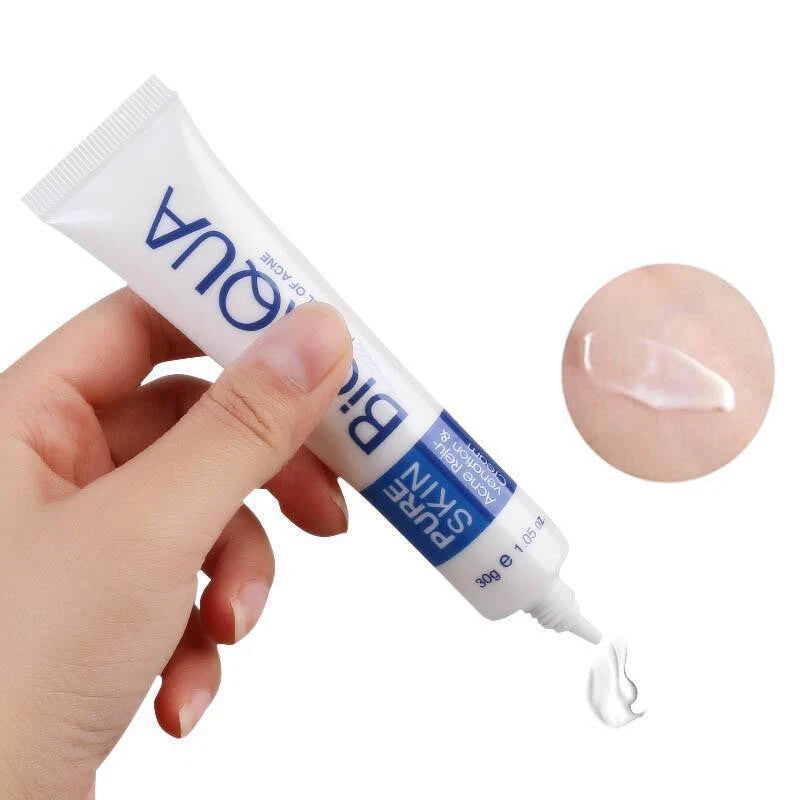 Acne Treatment Cream for Blemishes & Spots - 30ml Face Skin Care