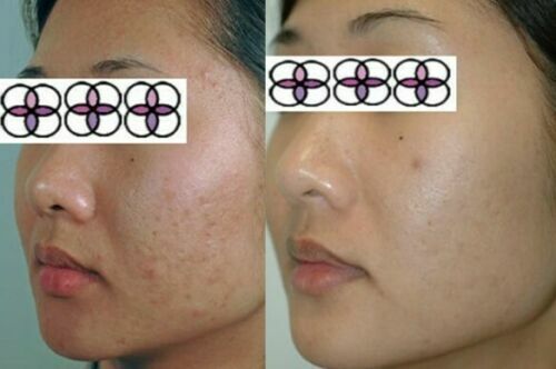 Glycolic Acid Face Cream for Acne and Scar Treatment - 10-70% Strength, 0.4oz