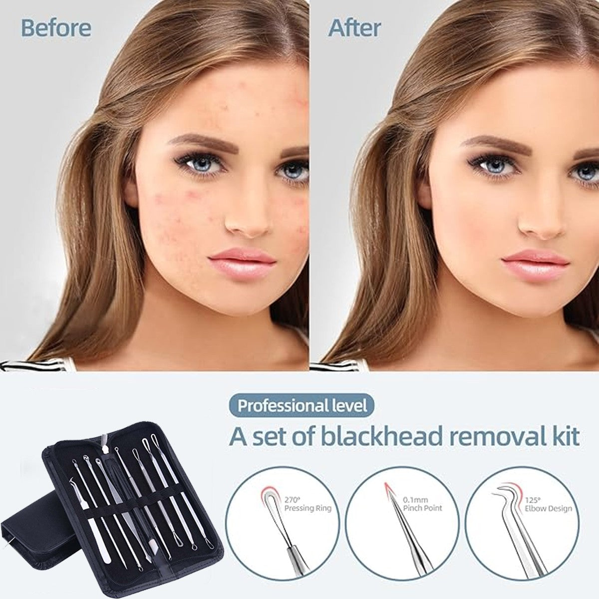 Professional Blackhead Remover Tool Kit with 16 Stainless Steel Extraction Tools