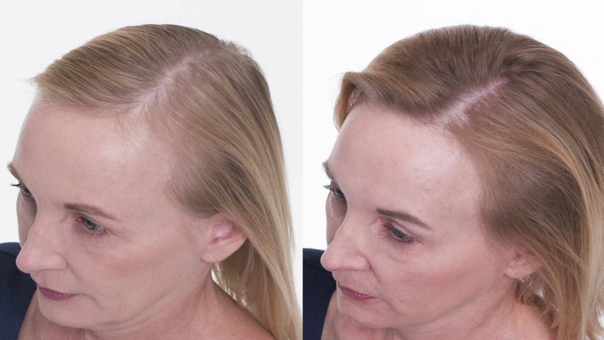 Hair Loss Prevention & Regrowth Treatment Kit - Natural Formula