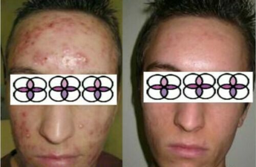 Glycolic Acid Face Cream for Acne and Scar Treatment - 10-70% Strength, 0.4oz