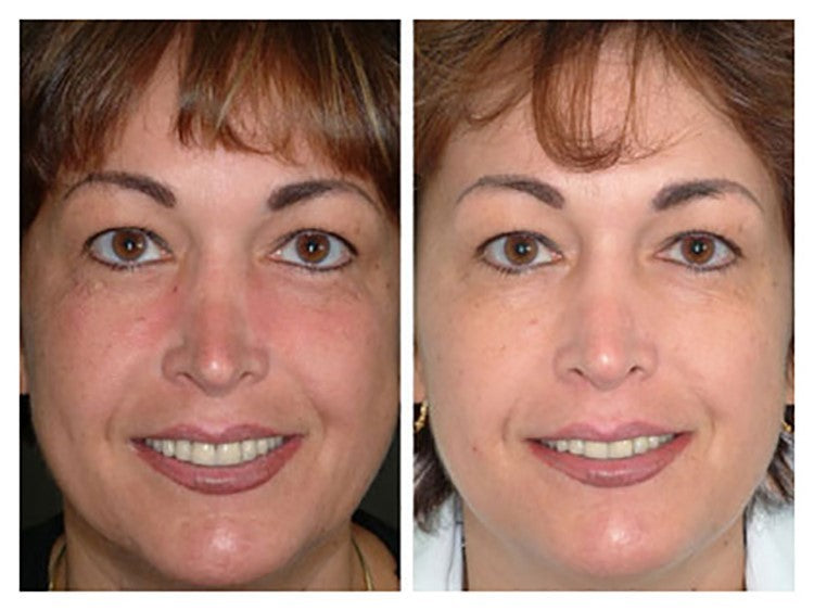 MicroDermabrasion AHA Cream Exfoliant Resurfacing Scrub -Anti Aging