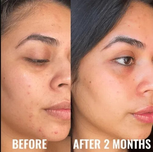 Niacinamide 10% Zinc 1% Hyaluronic Acid Serum for Oily Skin - Acne & Blemish Control