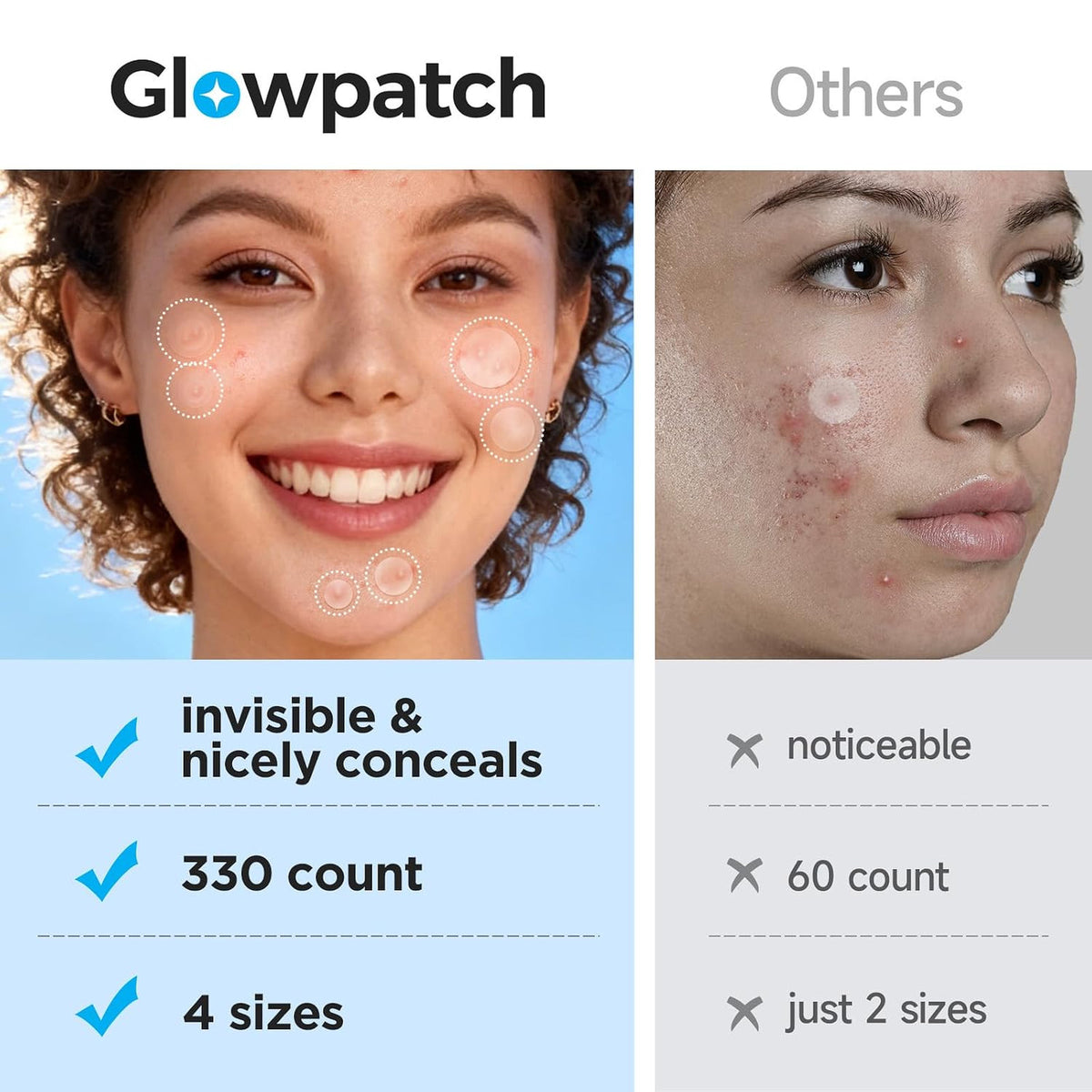 Invisible Hydrocolloid Acne Patches 330 Count - Discreet Spot Treatment