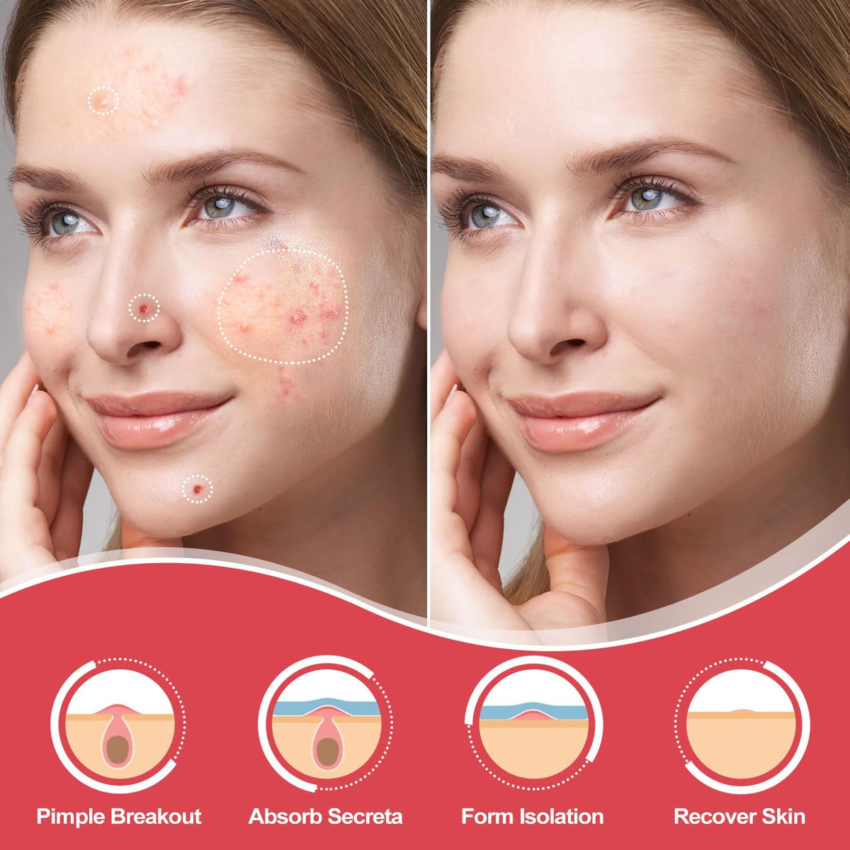 Hydrocolloid Acne Patches for Face, 216 Count