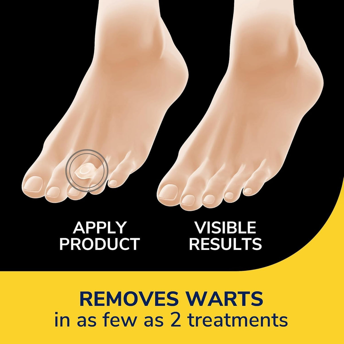 Maximum Strength Wart Remover - 14 ct Clear Discreet Bandages for