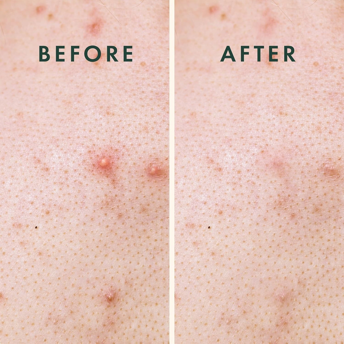 Large Hydrocolloid Pimple Patches - 50mm Absorbent Blemish Cover for Face & Body