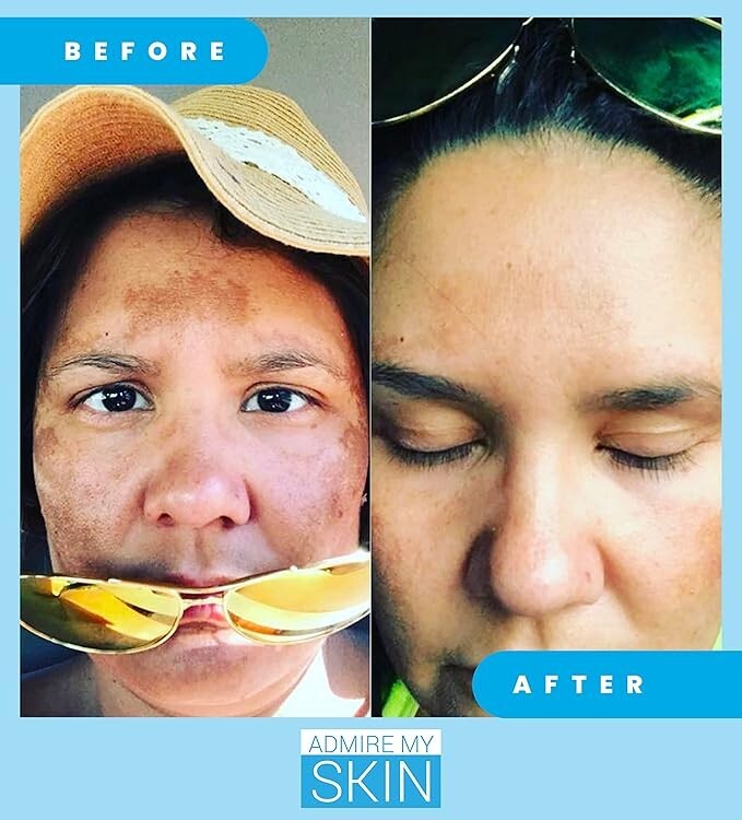 Dark Spot Corrector Serum for Face - Brightening Hyperpigmentation Treatment
