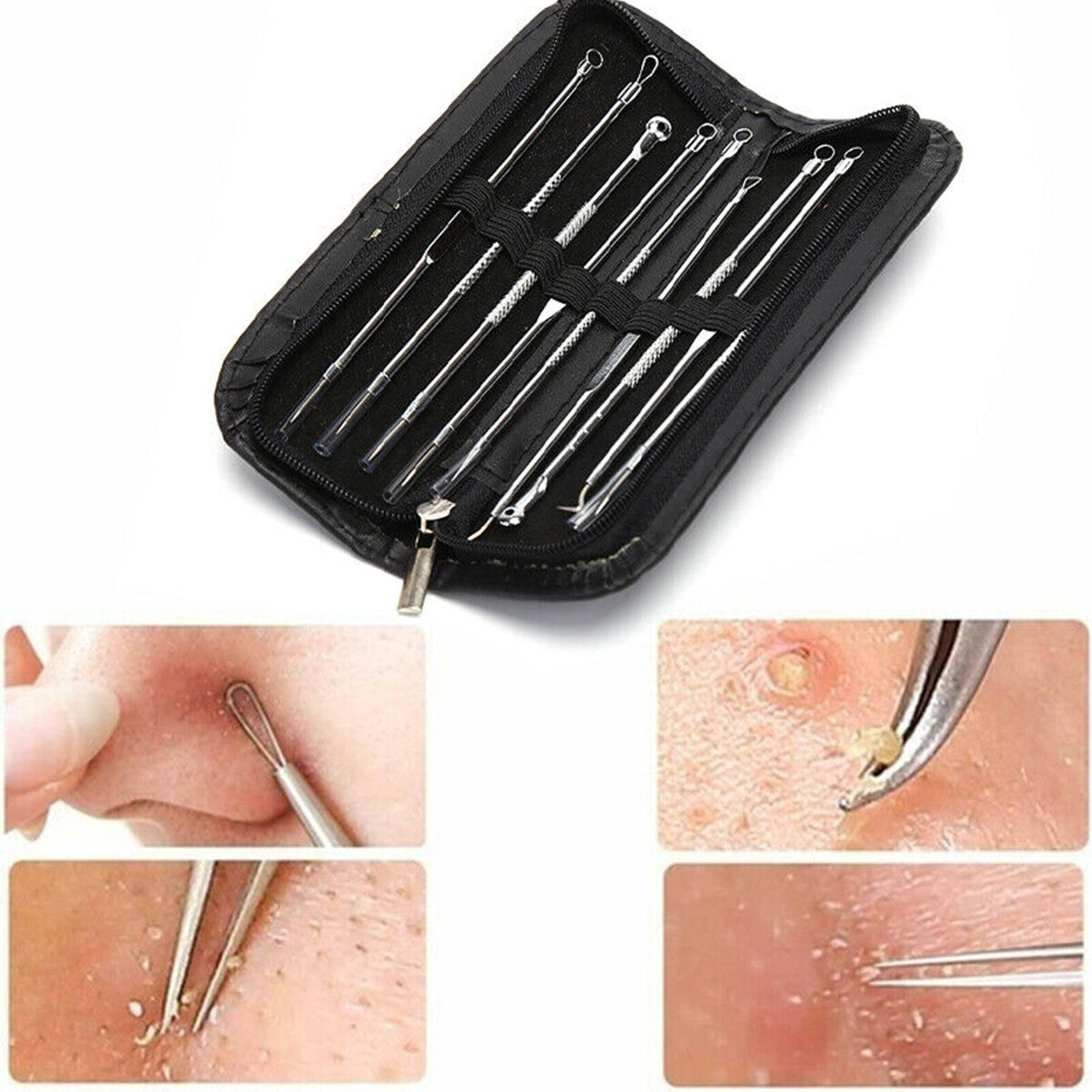 9Pcs Blackhead Acne Pimple Extractor Kit with Travel Case - Professional Skin Care Tools