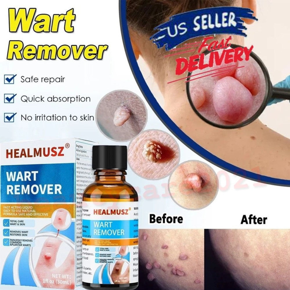 Wart Remover Liquid for Common and Plantar Warts - Natural Herbal Formula