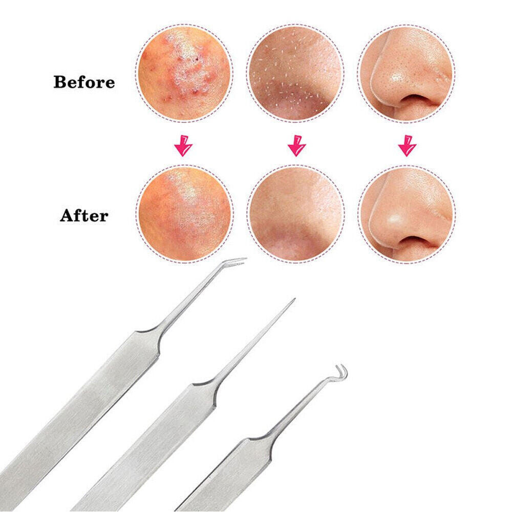 Blackhead Remover Tweezers Set - Pimple Blemish Extraction Tools
