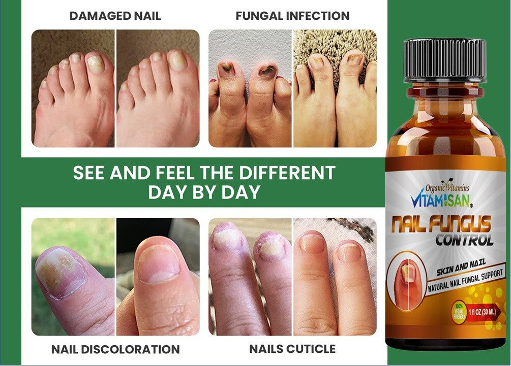 Antifungal Liquid Brush for Toenail Fungus - Max Strength 30ml