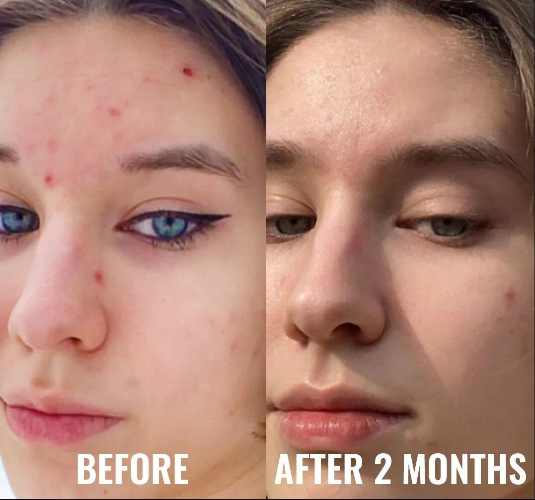 Niacinamide 10% Zinc 1% Hyaluronic Acid Serum for Oily Skin - Acne & Blemish Control