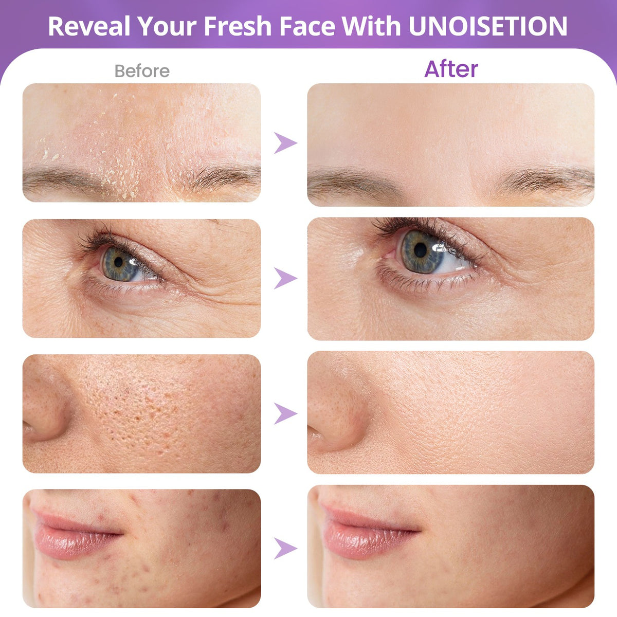 3-in-1 Mini Diamond Microdermabrasion Facial Peel Spray Machine for Home Use