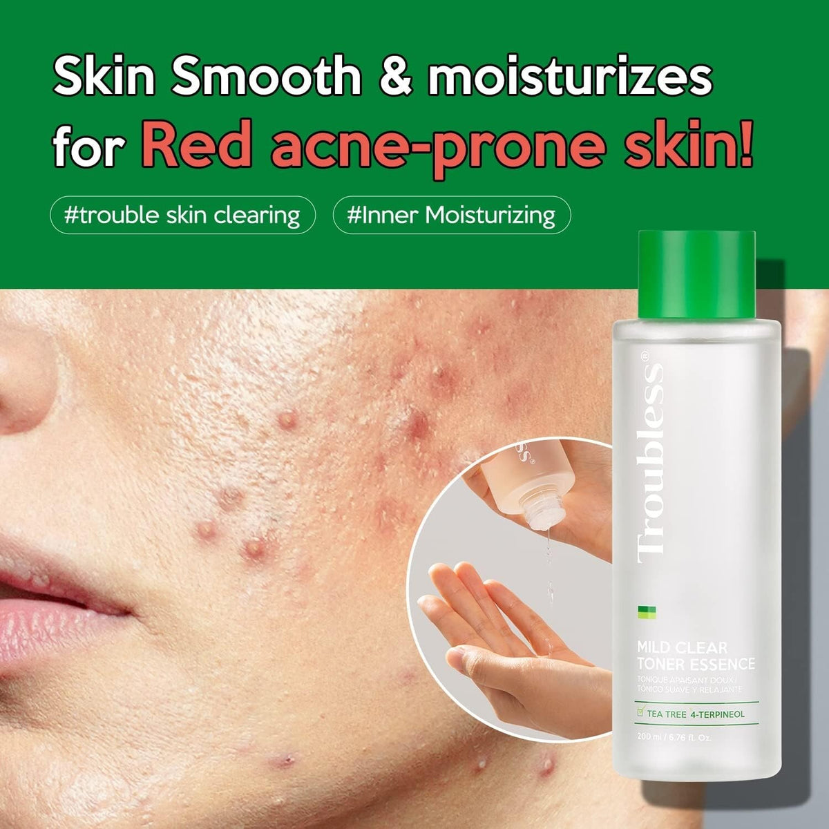 Troubless Mild Clear Toner Essence with Tea Tree & 4-Terpineol for Sensitive Skin - 6.76 fl oz