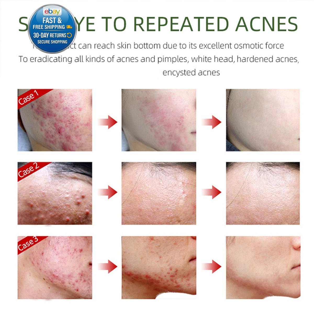 Herbal Acne Removing Face Cream for Oily Skin - Natural & Fast-Acting