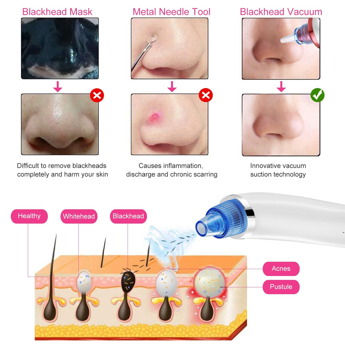 Electric Blackhead Remover Vacuum Pore Extractor with 4 Probes - USB Rechargeable