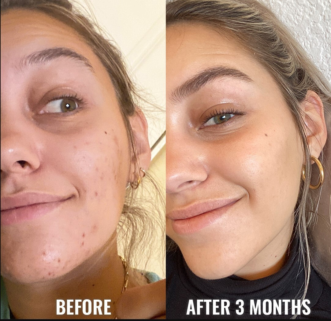 Niacinamide 10% Zinc 1% Hyaluronic Acid Serum for Oily Skin - Acne & Blemish Control