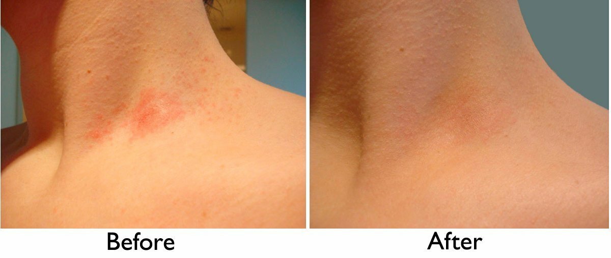 Intense Treatment Cream for Eczema, Psoriasis & Rosacea