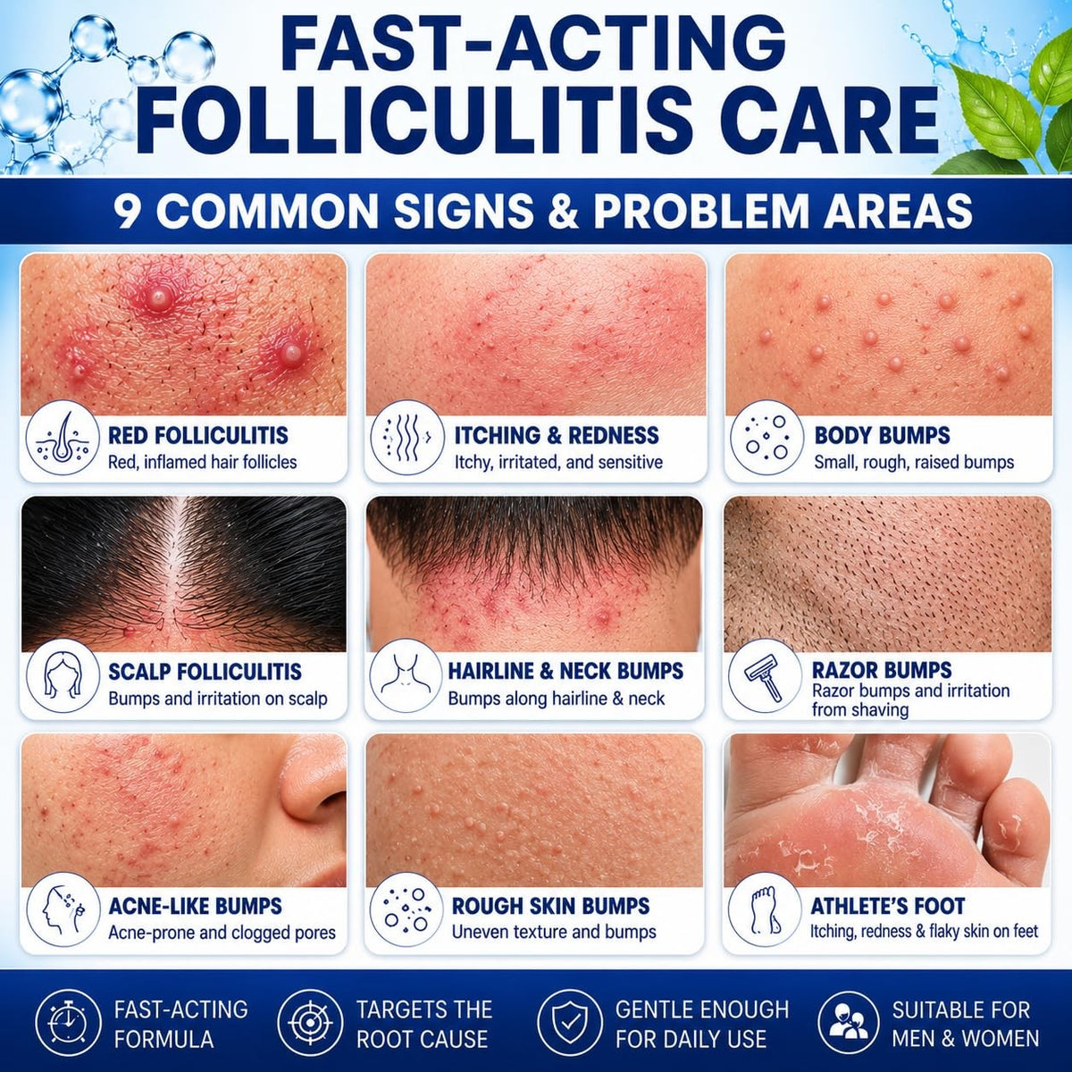 Folliculitis Treatment Cream with Benzoyl Peroxide & Tea Tree Oil - 3.53 oz