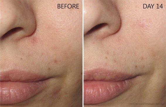 Niacinamide 10% Zinc 1% Hyaluronic Acid Serum for Oily Skin - Acne & Blemish Control