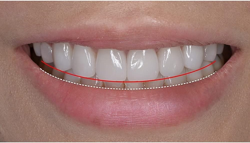 Realistic Silicone Teeth Veneers Covers for Adults – Easy Smile Transformation