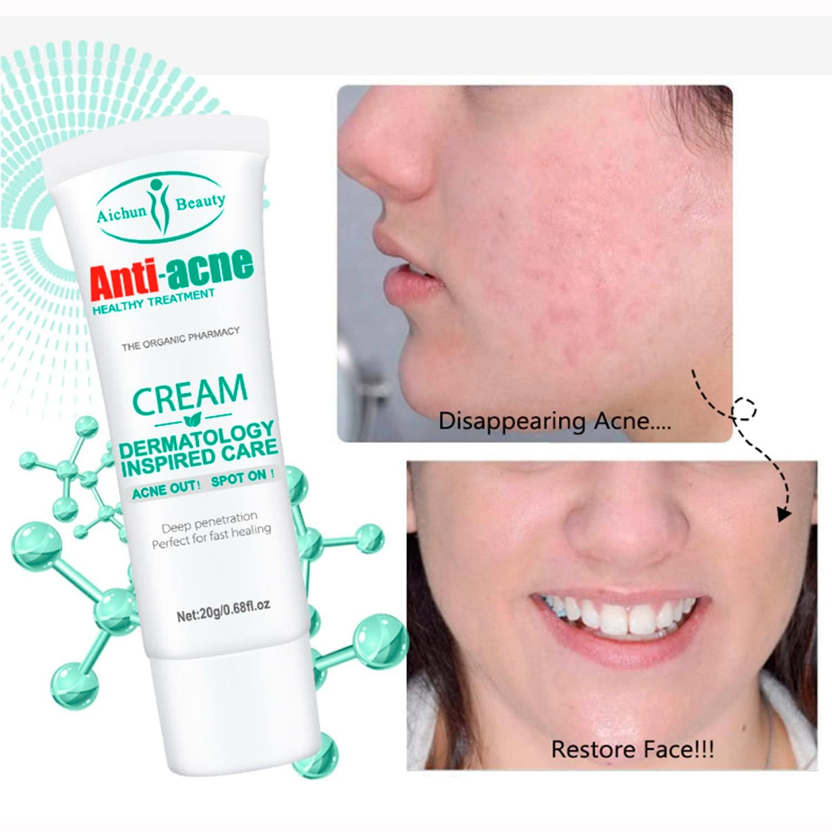 Anti-Acne Cream for Oily Skin Pores & Scar Reduction 20g