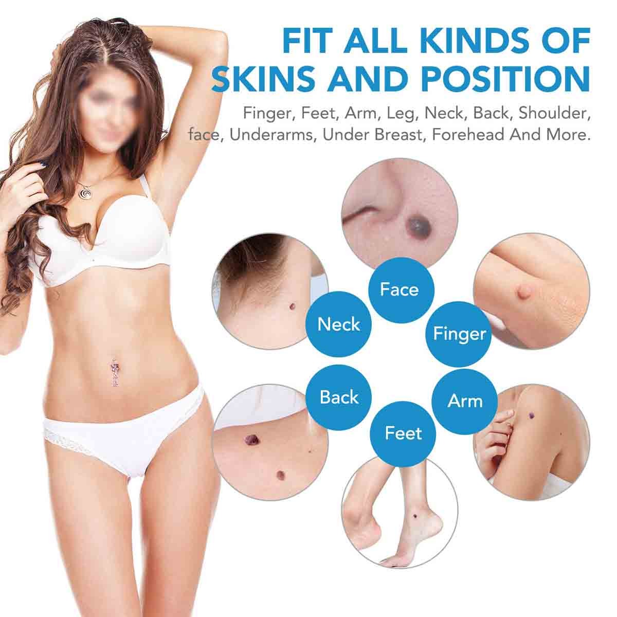 Skin Tag Remover Pen Kit with Bands for Face & Neck - Painless & Safe