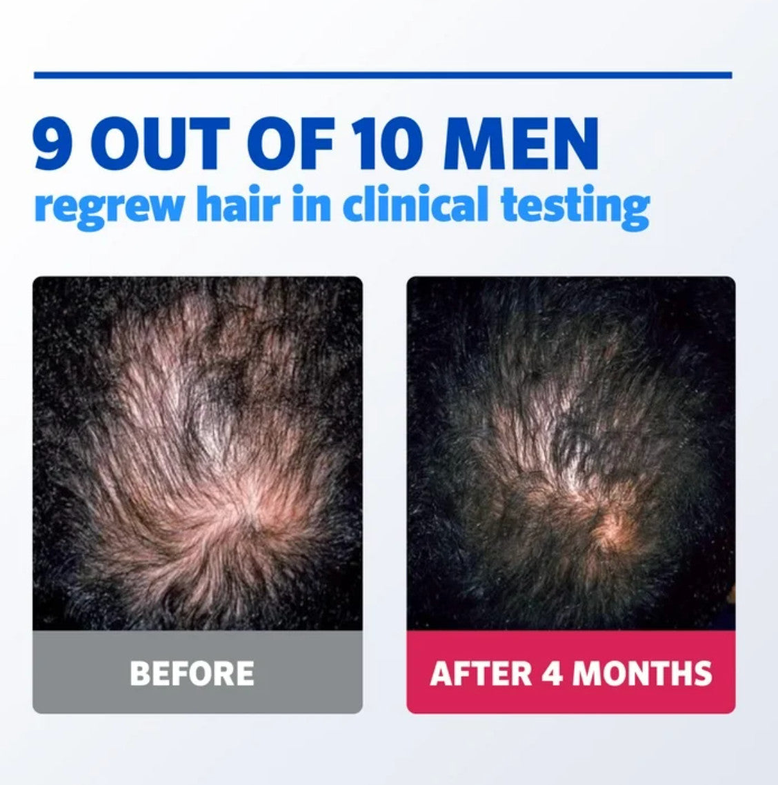 Men's Rogaine 5% Minoxidil Foam Hair Regrowth Treatment - 3 Month Supply