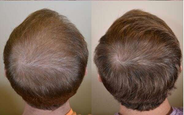 Hair Loss Treatment Shampoo - 16 Organic Oils for Men & Women