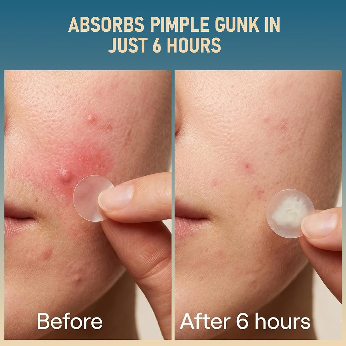 Hydrocolloid Acne Patches Set - 1250 Clear Facial Blemish Cover